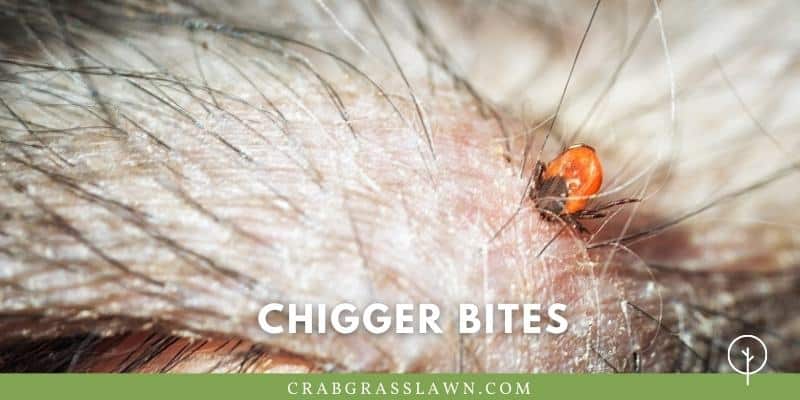 embedded chigger bite in skin